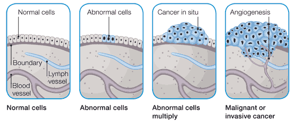 Slika 1: Karcinogeneza in angiogeneza